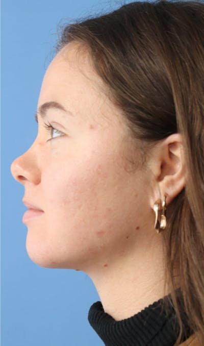 Jawline & Neck Filler Before & After Gallery - Patient 144976912 - Image 4
