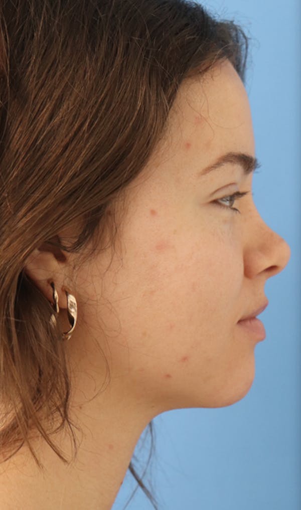 Jawline & Neck Filler Before & After Gallery - Patient 144976912 - Image 5