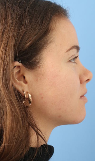 Jawline & Neck Filler Before & After Gallery - Patient 144976912 - Image 6