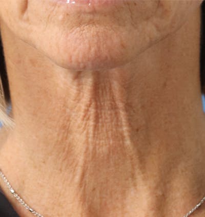 Jawline & Neck Filler Before & After Gallery - Patient 144976754 - Image 1