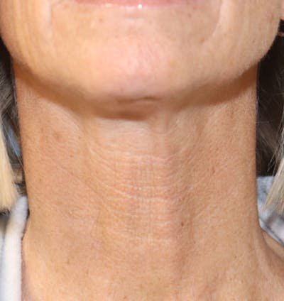 Jawline & Neck Filler Before & After Gallery - Patient 144976754 - Image 2