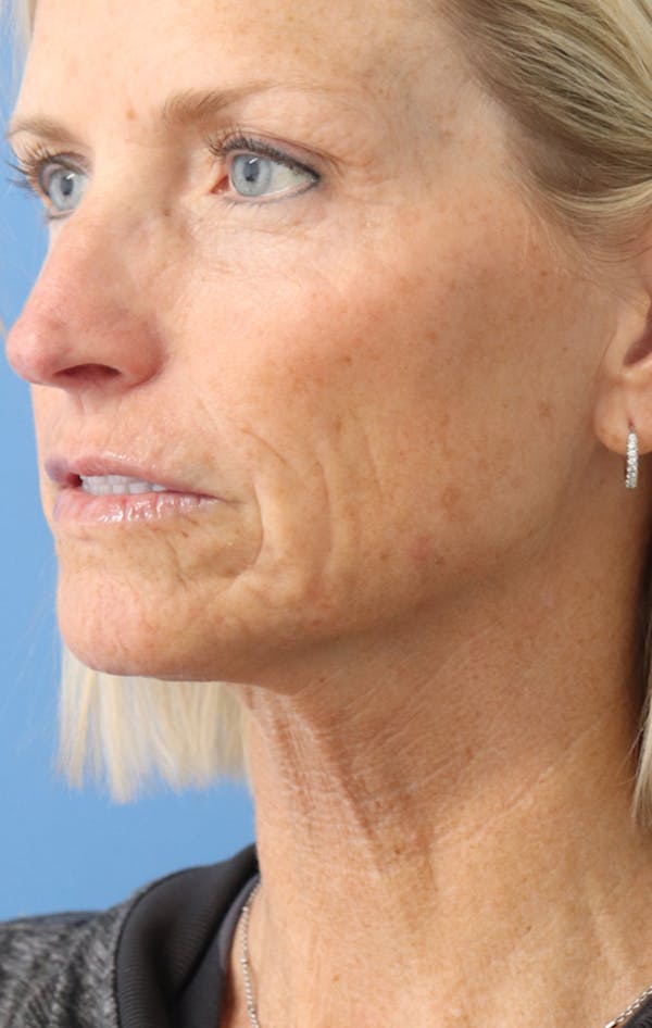 Jawline & Neck Filler Before & After Gallery - Patient 144976754 - Image 3