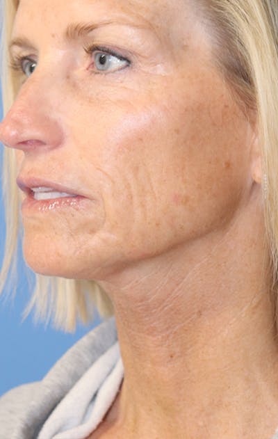 Jawline & Neck Filler Before & After Gallery - Patient 144976754 - Image 4