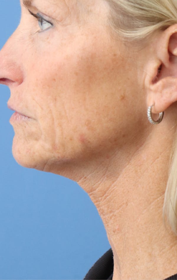 Jawline & Neck Filler Before & After Gallery - Patient 144976754 - Image 5
