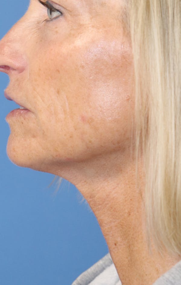 Jawline & Neck Filler Before & After Gallery - Patient 144976754 - Image 6