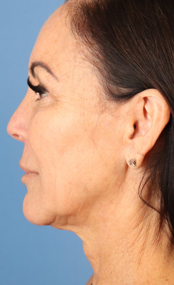 FaceTite Before & After Gallery - Patient 120347085 - Image 1