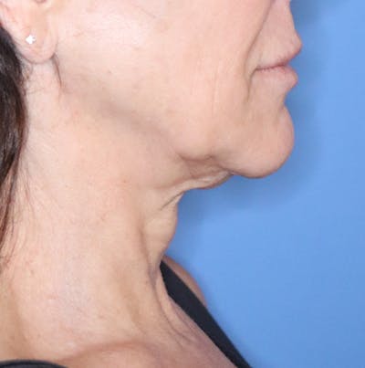 FaceTite Before & After Gallery - Patient 120347086 - Image 1