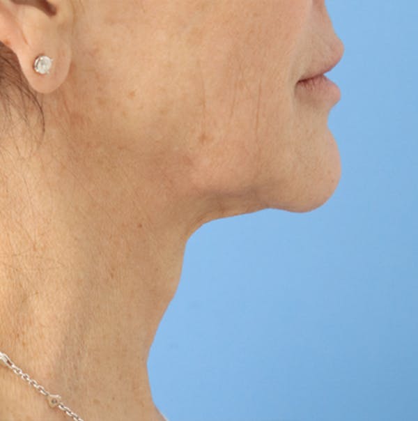 FaceTite Before & After Gallery - Patient 120347086 - Image 2