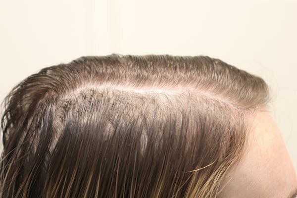 Hair Restoration with Exosomes Gallery - Patient 77037162 - Image 1