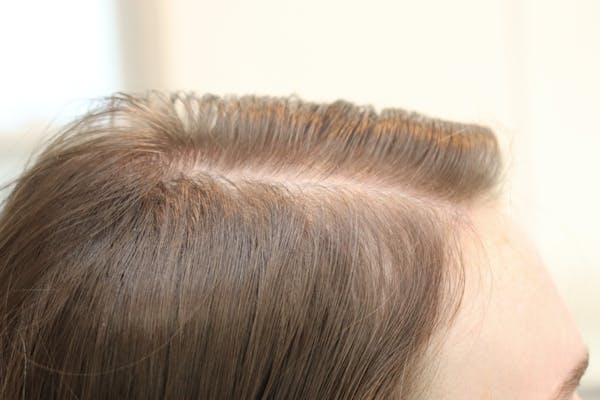 Hair Restoration with Exosomes Gallery - Patient 77037162 - Image 2