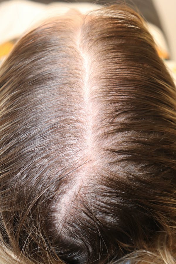 Hair Restoration with Exosomes Before & After Gallery - Patient 77037162 - Image 3