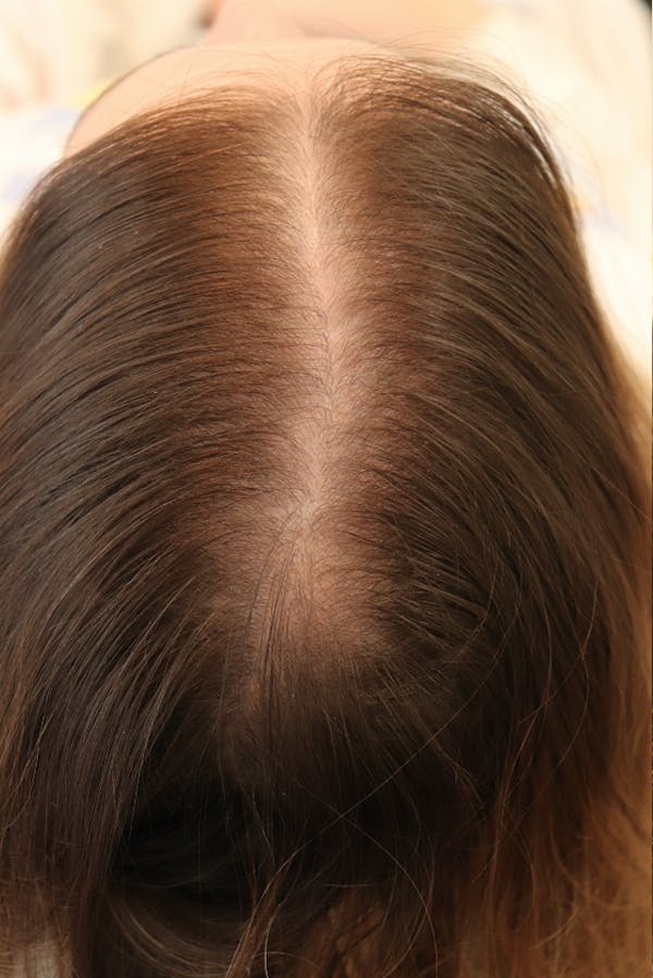 Hair Restoration with Exosomes Gallery - Patient 77037162 - Image 4