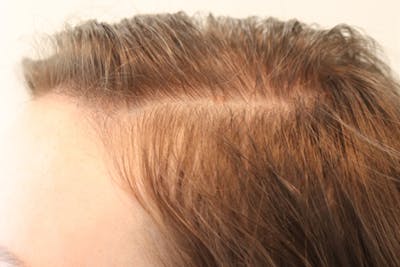 Hair Restoration with Exosomes Before & After Gallery - Patient 77037162 - Image 6