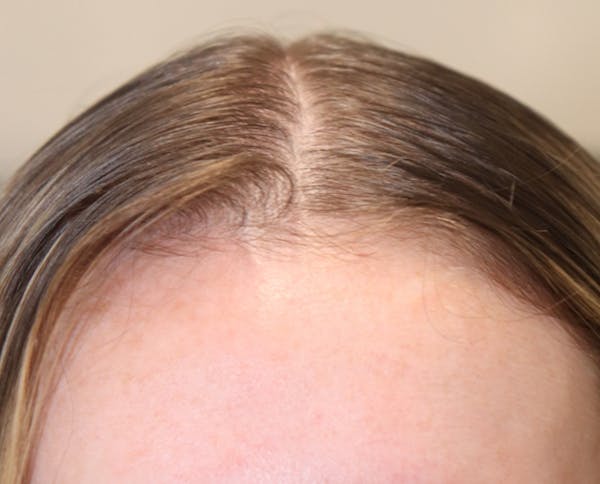 Hair Restoration with Exosomes Gallery - Patient 77037162 - Image 7