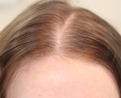Hair Restoration with Exosomes Before & After Gallery - Patient 77037162 - Image 8