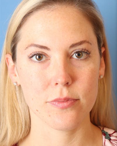 AccuTite Before & After Gallery - Patient 102408273 - Image 1