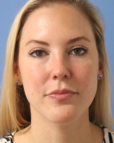 AccuTite Before & After Gallery - Patient 102408273 - Image 2