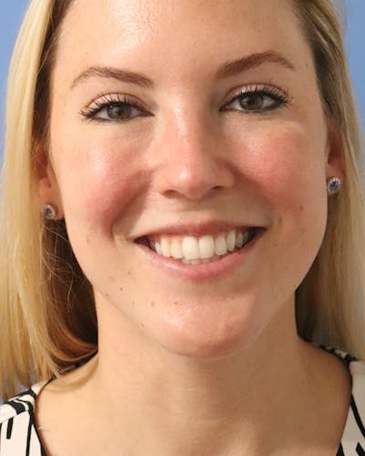 AccuTite Before & After Gallery - Patient 102408273 - Image 4