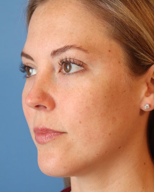 AccuTite Before & After Gallery - Patient 102408273 - Image 5