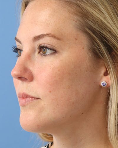 AccuTite Before & After Gallery - Patient 102408273 - Image 6