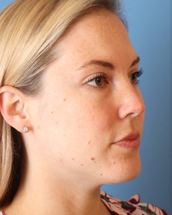 AccuTite Before & After Gallery - Patient 102408273 - Image 7