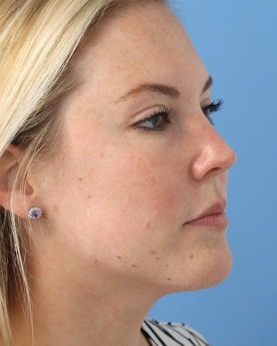 AccuTite Before & After Gallery - Patient 102408273 - Image 8