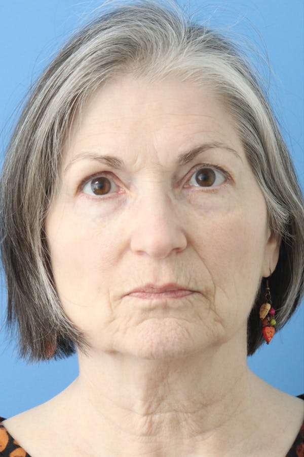 Brow Lift Before & After Gallery - Patient 122660349 - Image 1