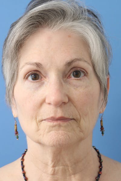 Brow Lift Before & After Gallery - Patient 122660349 - Image 2