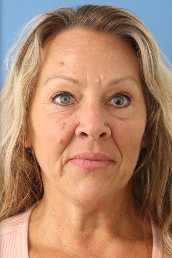 Eyelid Lift Before & After Gallery - Patient 122660352 - Image 2