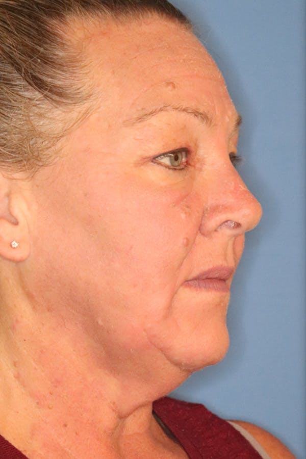 Eyelid Lift Before & After Gallery - Patient 122660352 - Image 3
