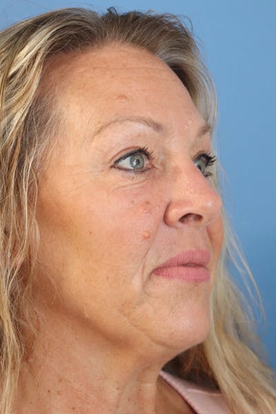 Eyelid Lift Before & After Gallery - Patient 122660352 - Image 4