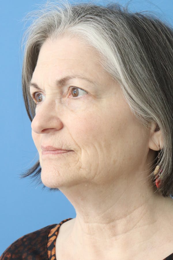 Eyelid Lift Before & After Gallery - Patient 122660357 - Image 5