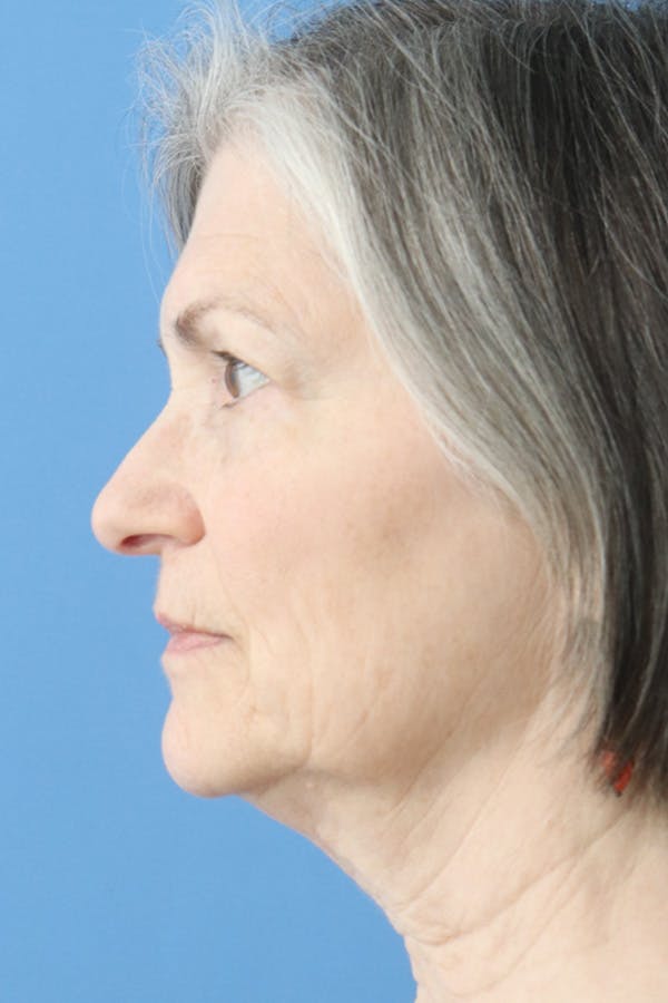 Eyelid Lift Before & After Gallery - Patient 122660357 - Image 3
