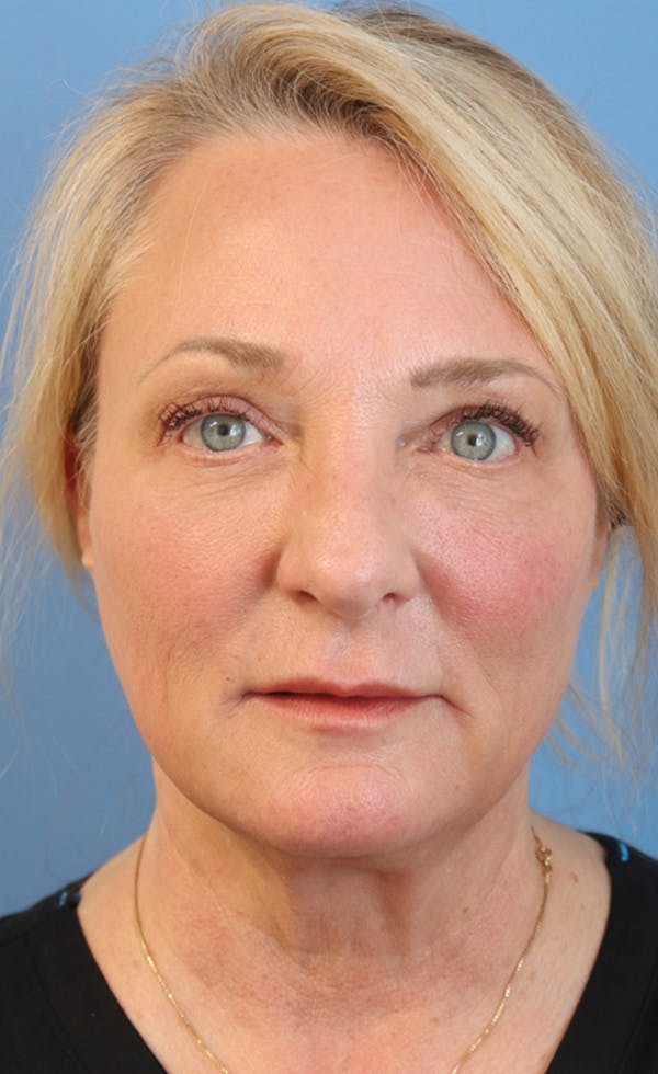 FaceTite Before & After Gallery - Patient 122660365 - Image 2