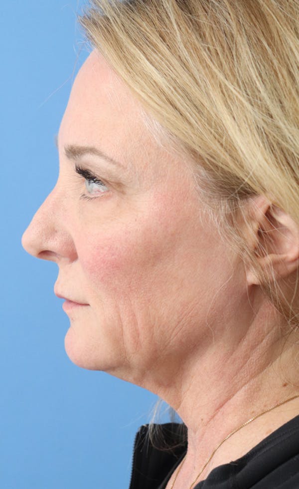 FaceTite Before & After Gallery - Patient 122660365 - Image 3