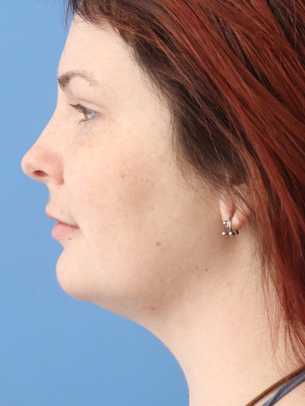 Facial Liposuction Before & After Gallery - Patient 122660370 - Image 4