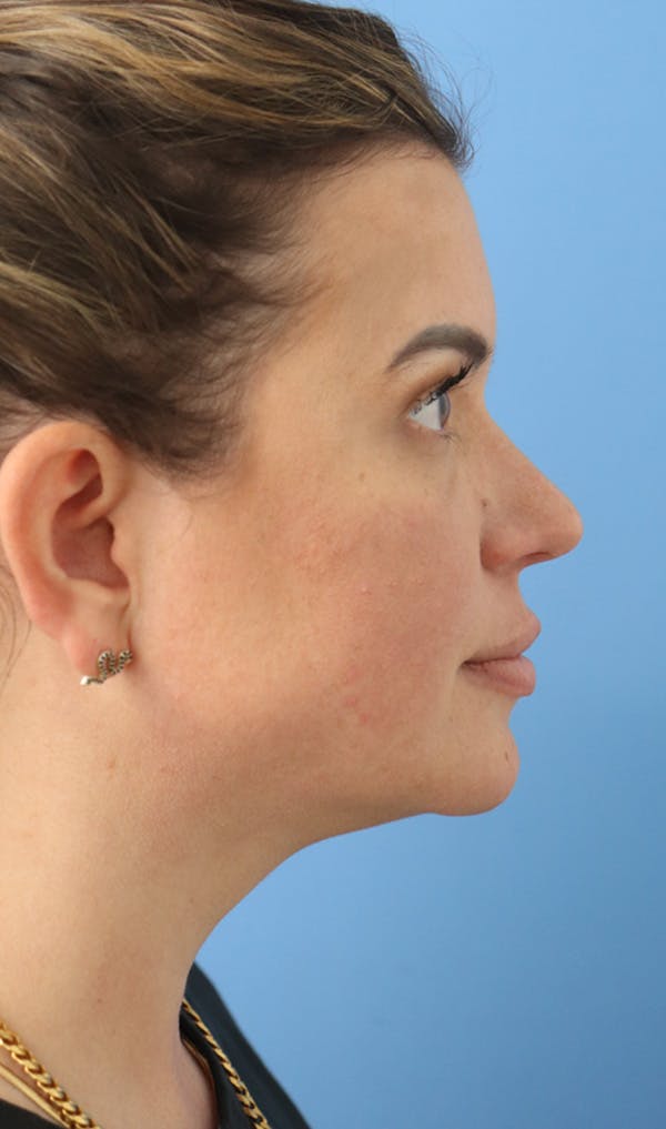 Jawline & Neck Filler Before & After Gallery - Patient 144976915 - Image 1