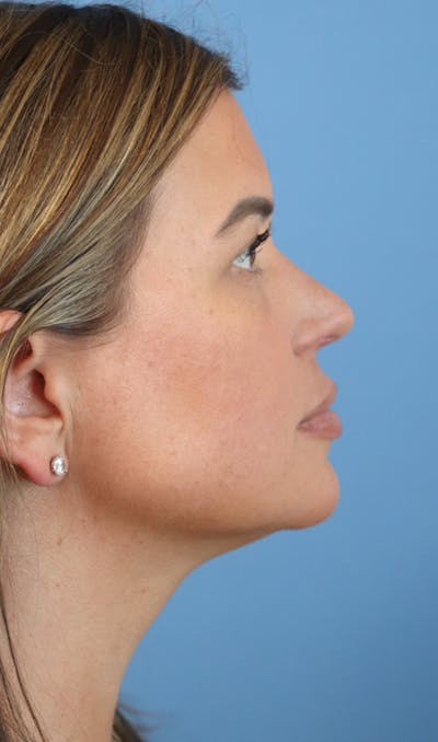 Jawline & Neck Filler Before & After Gallery - Patient 144976915 - Image 2