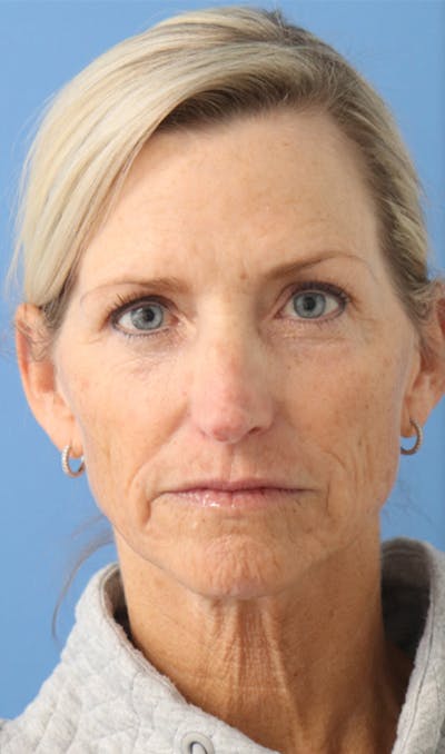 Cheek & Under Eye Filler Before & After Gallery - Patient 144976917 - Image 1