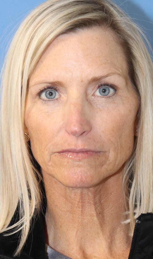 Cheek & Under Eye Filler Before & After Gallery - Patient 144976917 - Image 2