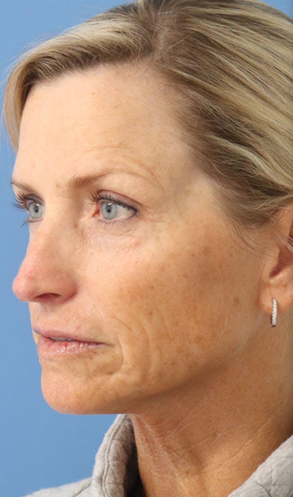 Cheek & Under Eye Filler Before & After Gallery - Patient 144976917 - Image 3