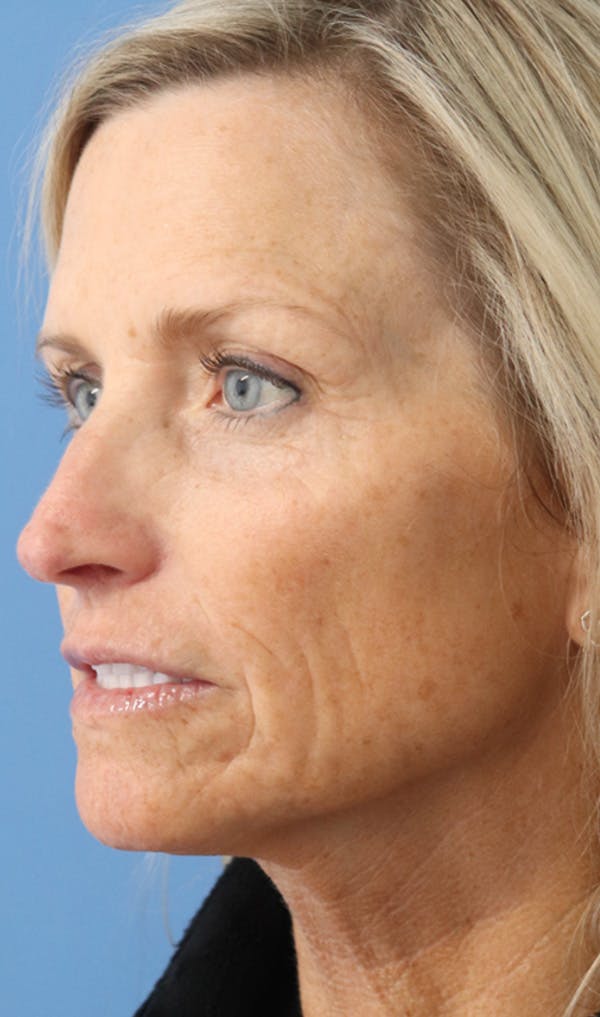 Filler Refinement Before & After Gallery - Patient 122660377 - Image 4
