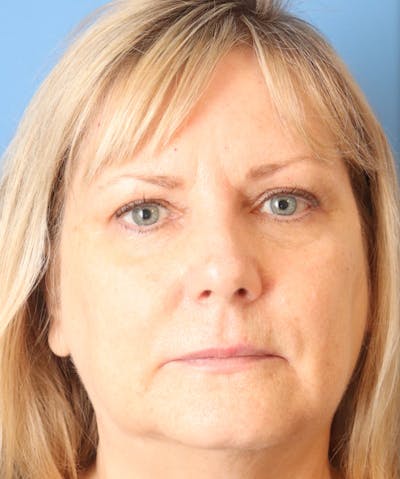Lip Filler Before & After Gallery - Patient 144976918 - Image 1