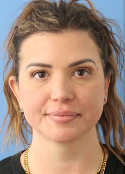 Mole Removal Before & After Gallery - Patient 122660409 - Image 1