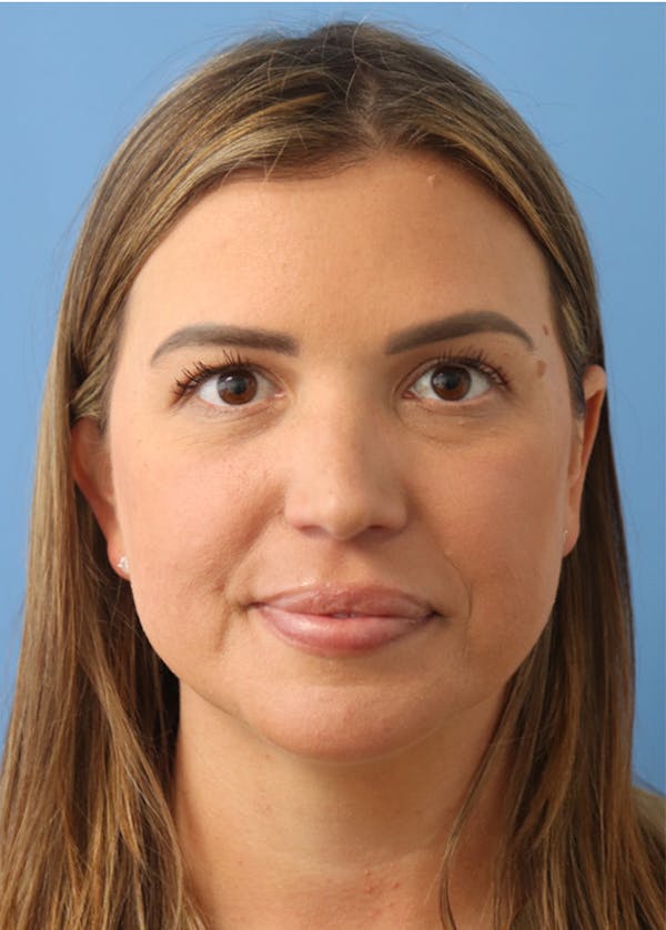 Mole Removal Before & After Gallery - Patient 122660409 - Image 2