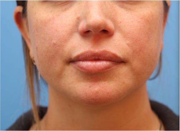 Blemish & Mole Removal Gallery - Patient 122660409 - Image 3