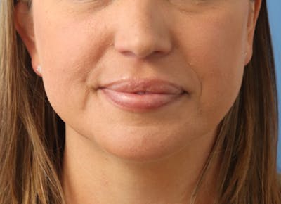 Mole Removal Before & After Gallery - Patient 122660409 - Image 4