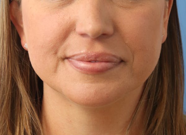 Mole Removal Before & After Gallery - Patient 122660409 - Image 4