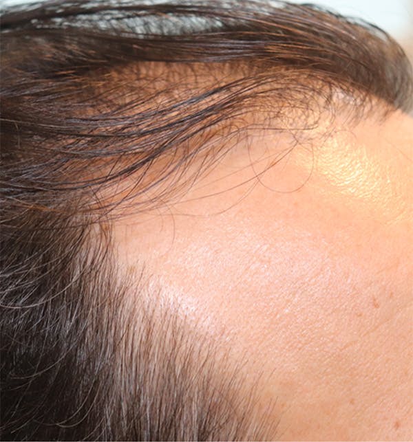 Hair Restoration with Exosomes Gallery - Patient 122660440 - Image 5