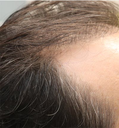 Hair Restoration with Exosomes Gallery - Patient 122660440 - Image 6